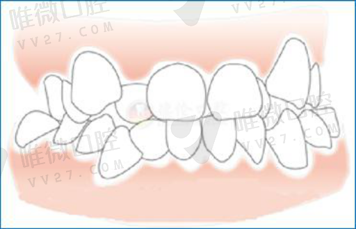 种植牙跟假牙有什么区别,种植牙8年后(图1)